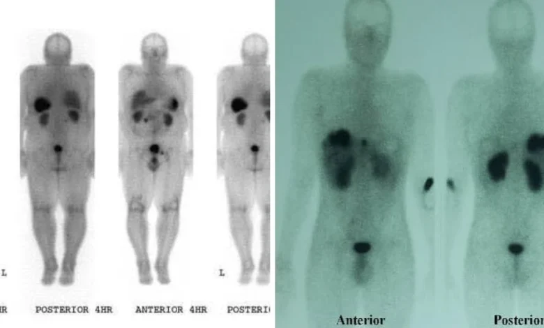 IMG 20250728 WA0040 ஆக்ட்ரியோடைடு ஸ்கேன் என்றால் என்ன? Theechudar